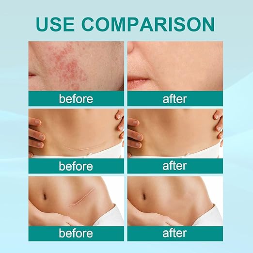 Scar Spray - Buy 1 Get 1 Free
