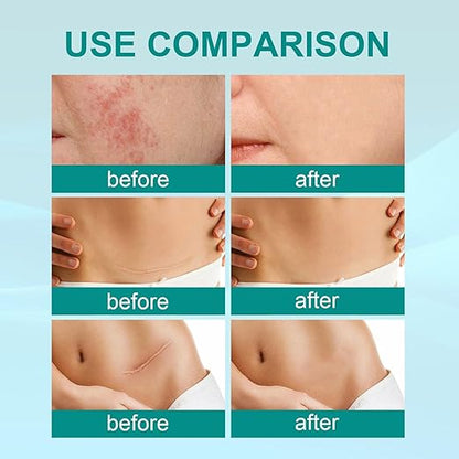 Scar Spray - Buy 1 Get 1 Free